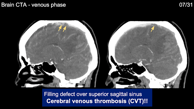 藏在腦出血背後的腦栓塞 - Survey of hypercoagubility, Cerebral venous thrombosis, and Protein S deficiency